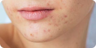 Vše o periorální dermatitidě