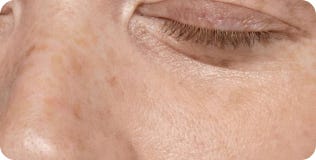 Jak na pigmentov&eacute; skvrny