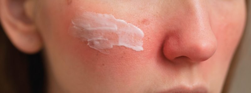 Rosacea a kosmetika – které látky v ní hledat a kterým se vyhnout?