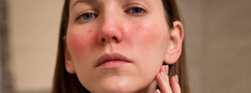 Rosacea neboli růžovka. Příznaky, spouštěče a účinné tipy na léčbu