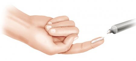 Jednotka prstu (FTU), použití kortikoidů